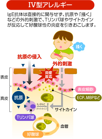 Ⅳ型アレルギー