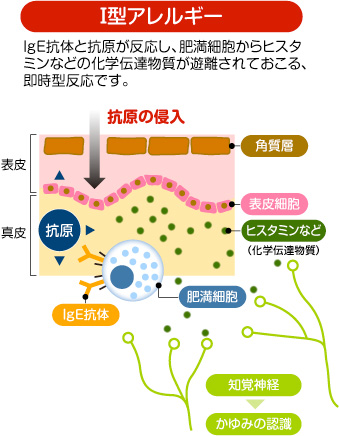 Ⅰ型アレルギー