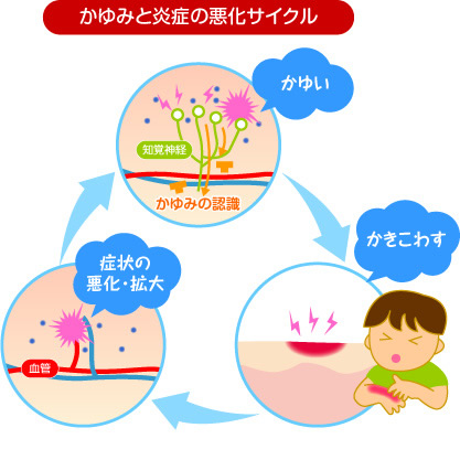 かゆみと炎症の悪化サイクル