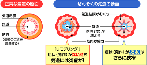 正常な気道の断面　ぜんそくの患者さんの気道の断面