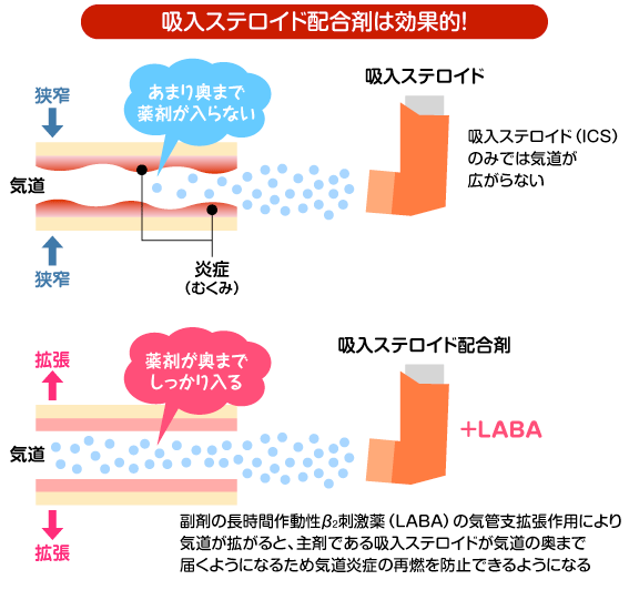 吸入ステロイド配合剤は効果的！