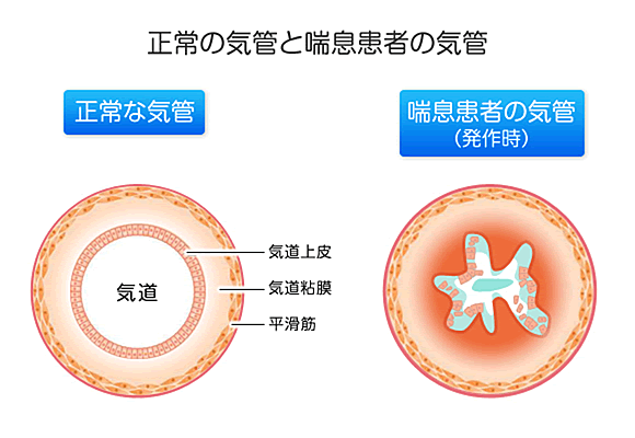 正常の気管とぜんそく患者の気管(発作時)