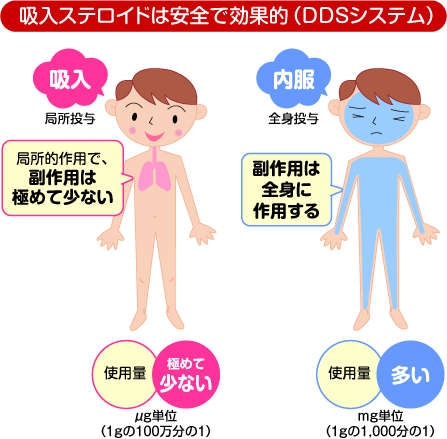 吸入ステロイドは安全で効果的（DDSシステム）