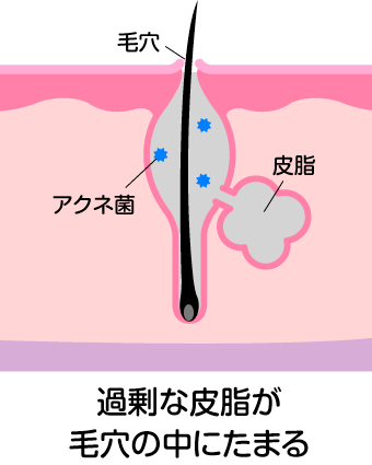 白ニキビ