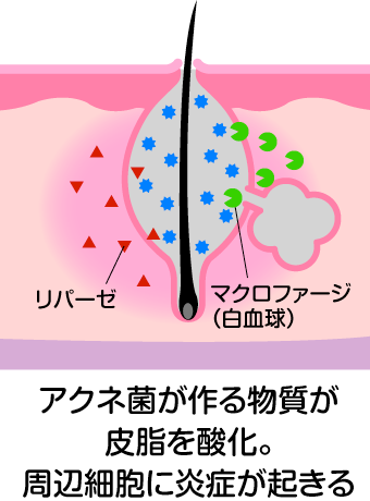 赤ニキビ