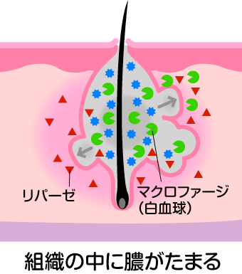 黄ニキビ