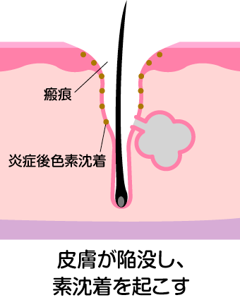 瘢痕(クレーター)