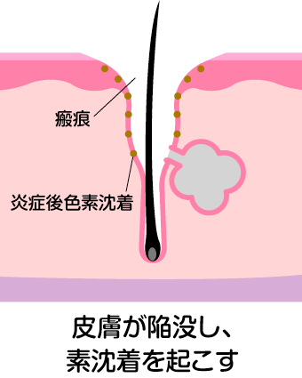 瘢痕（クレーター）